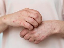 Suspek Cacar Monyet MPox di Brebes Ternyata Hoaks, Dinkes: Jateng Nol Kasus
