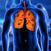 Pneumonia