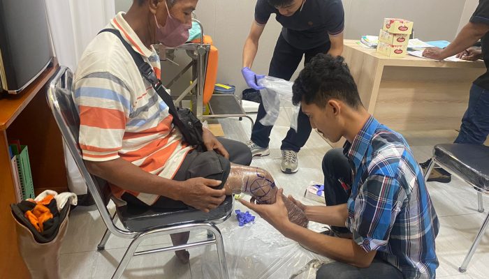 Hingga 2025 Mendatang, Program ‘1.000 Kaki Palsu’ Tersedia di RS Panti Wilasa Dr Cipto, Gratis dan Nyaman Pakai