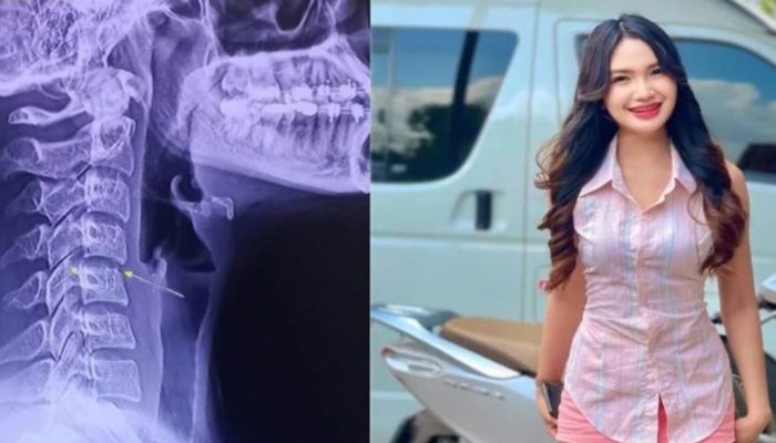 Ping Chayada Penyanyi Asal Thailand yang Meninggal Dunia Usai Pijat Leher, Begini Gejalanya